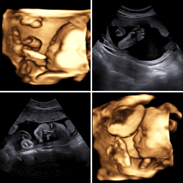 Ultraschallbilder Frauenärztin Peine